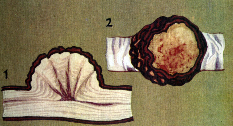 Разрезы стволового капа березы: 1 - радиальный, 2 - поперечный